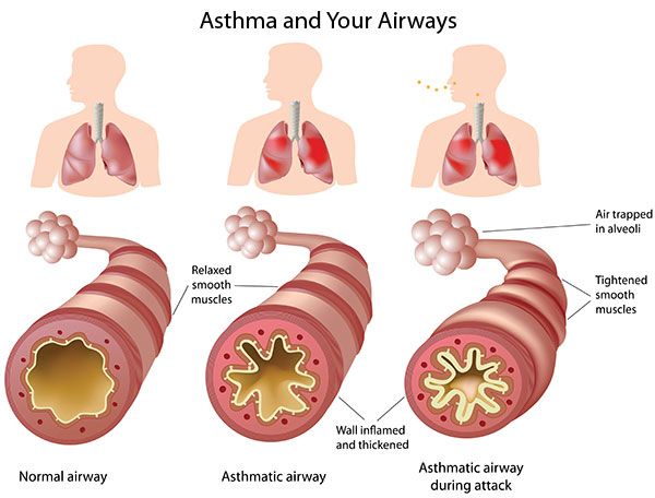 bronchial asthma Archives - The Holistic Care